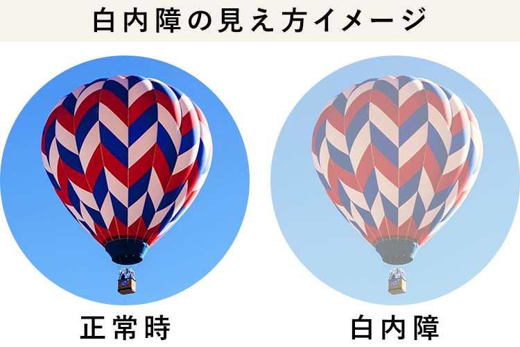 白内障画像