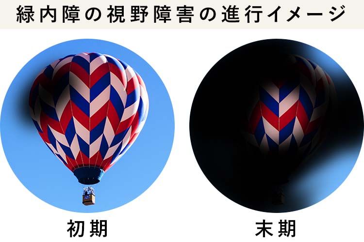 緑内障画像